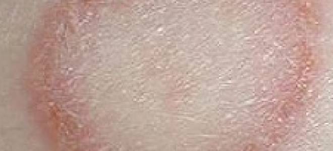 Лишай от кота у ребенка лечение